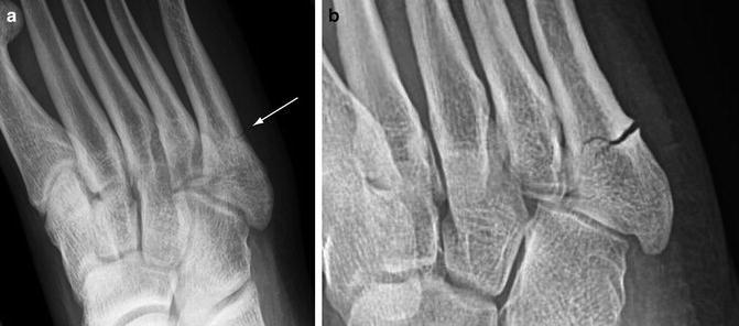 hình ảnh gãy xương do mỏi