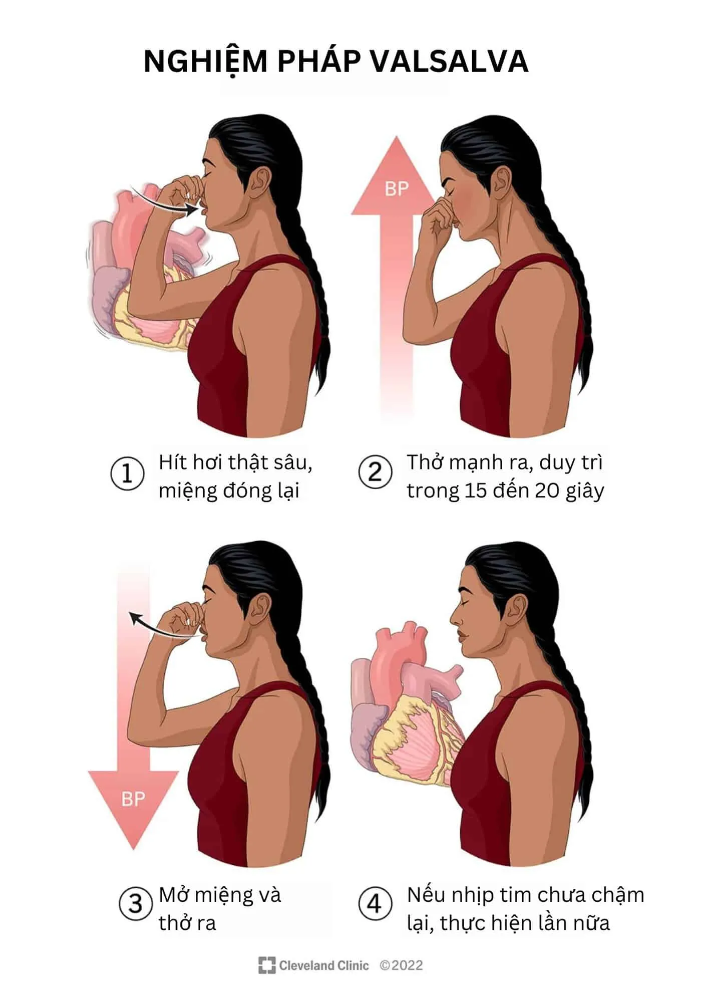 nghiệm pháp Valsalva