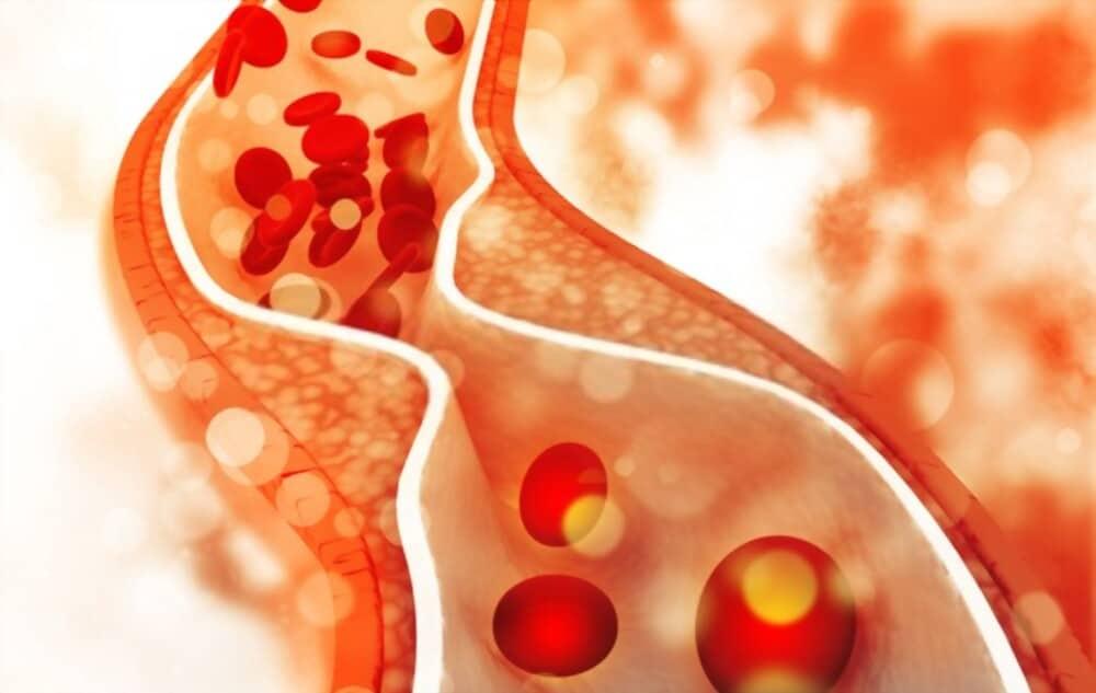 nguyên nhân gây hội chứng thuyên tắc mỡ