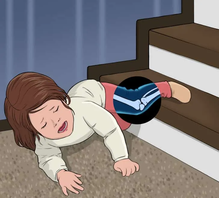 Té ngã làm 2 chân không đều nhau