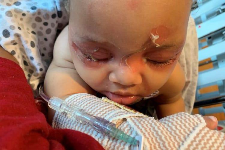 Triệu chứng của hội chứng bong vảy da do tụ cầu SSSS