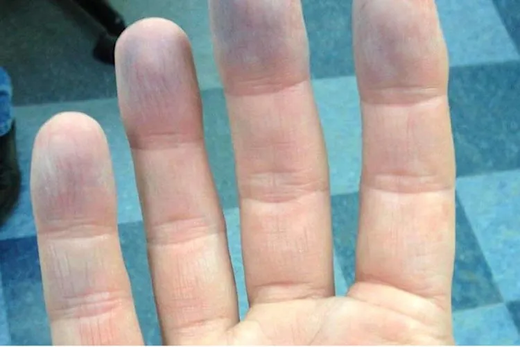 Hội chứng xanh tím da có triệu chứng dễ nhận biết nhất trước hết là tình trạng một số vùng da bị chuyển màu xanh tím, tái nhợt nhưng không phải do tê cóng