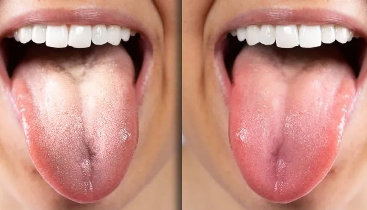 Nguyên nhân gây bệnh lưỡi trắng