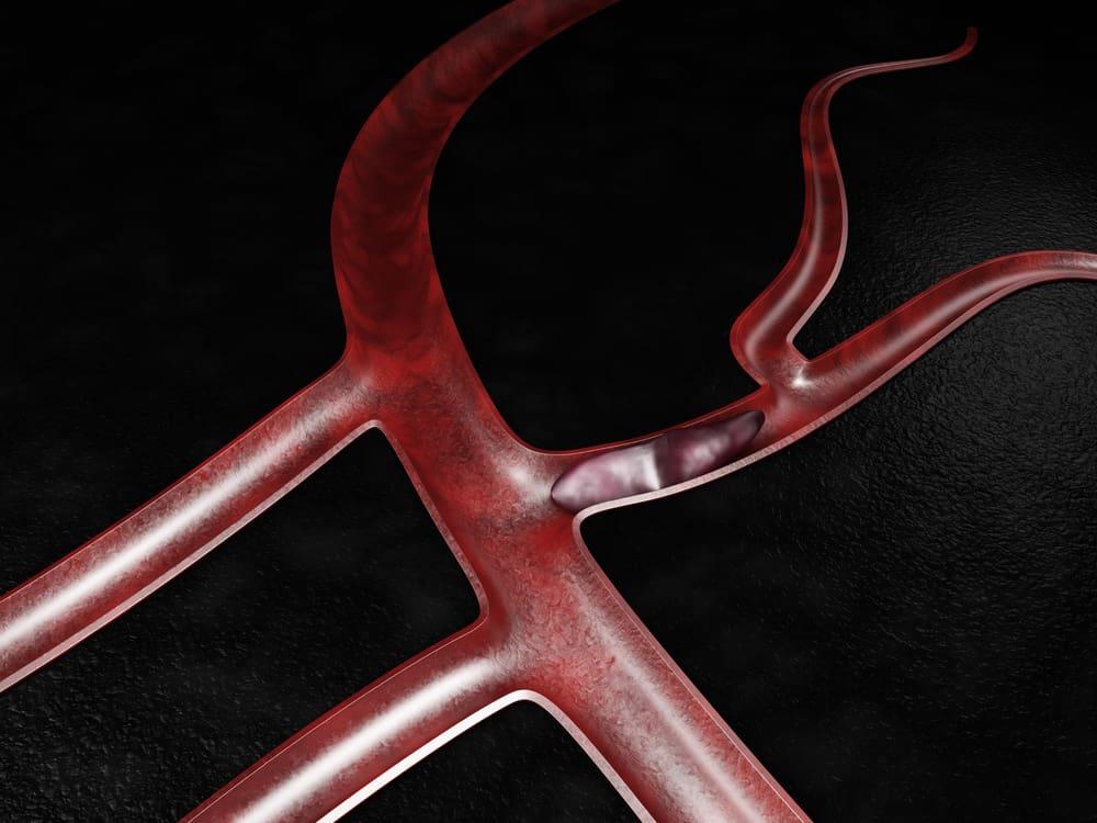 nguyên nhân gây thuyên tắc khí