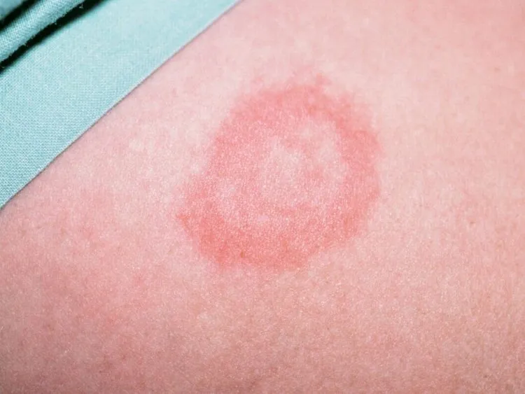 Phát ban đỏ bệnh Lyme