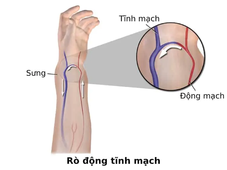 rò động tĩnh mạch 1