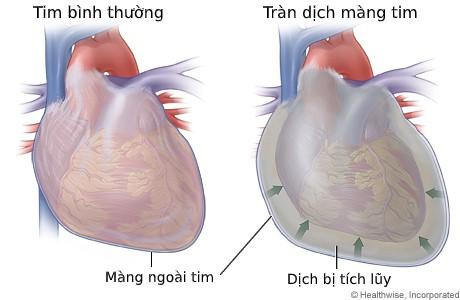 tràn dịch màng tim