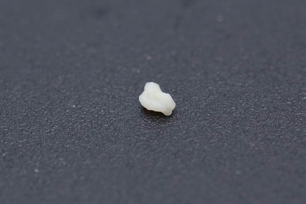 hình ảnh sỏi amidan