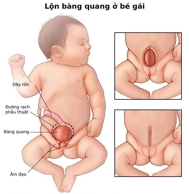lộn bàng quang 1