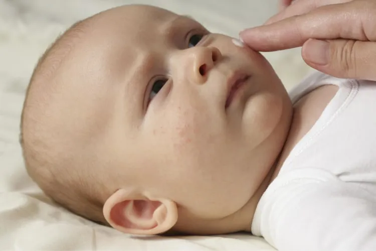 Bôi thuốc chữa mụn sữa cho trẻ sơ sinh và trẻ nhỏ.