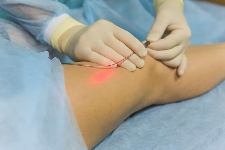 Thủ thuật cắt đốt