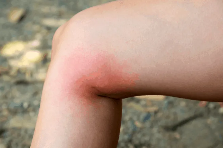 Cách xác định các mức độ bỏng