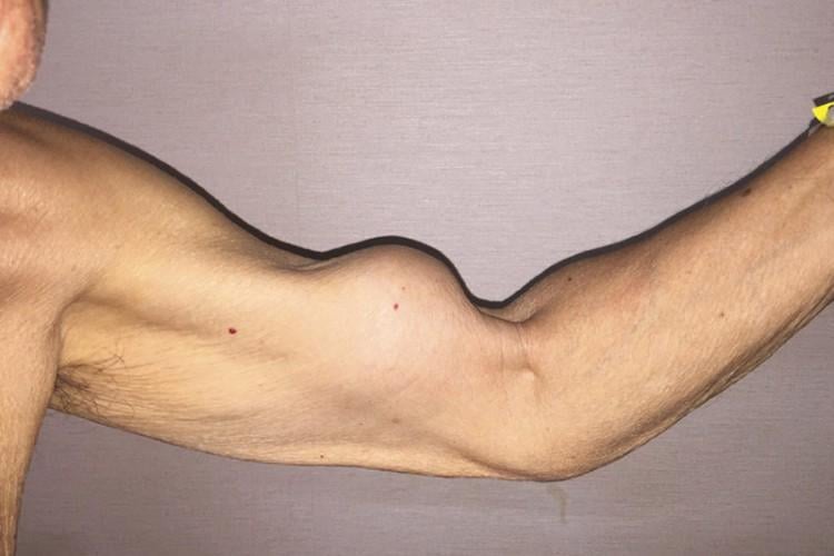 Chấn thương cơ nhị đầu cánh tay