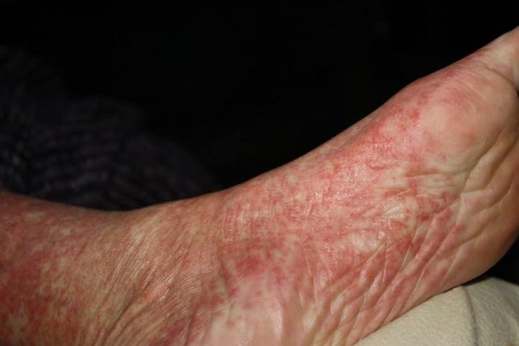 Chứng cryoglobulin huyết có triệu chứng ban xuất huyết ở da