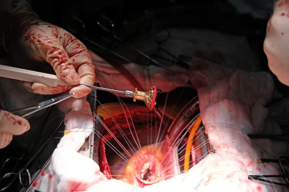 điều trị hở van động mạch chủ