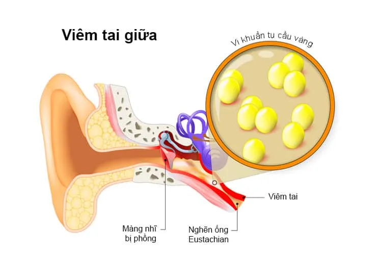 Dấu hiệu viêm tai giữa
