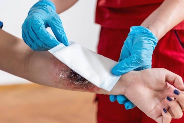 Cách sơ cấp cứu khi bị bỏng