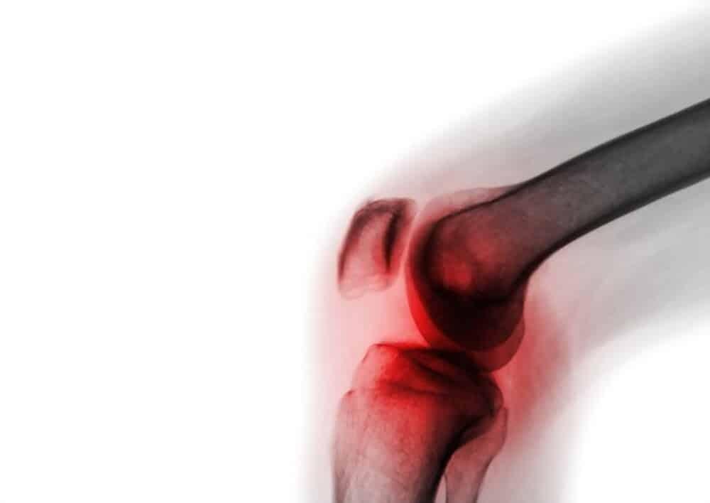 nguyên nhân gây viêm khớp nhiễm khuẩn