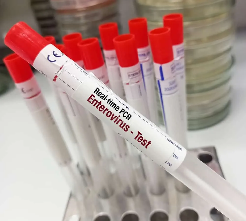 chẩn đoán nhiễm Enterovirus