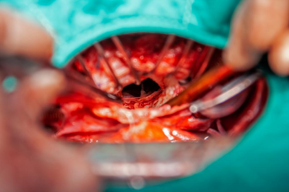 phẫu thuật điều trị sa van hai lá