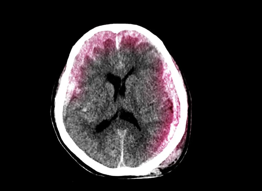 tụ máu dưới màng cứng là bệnh gì