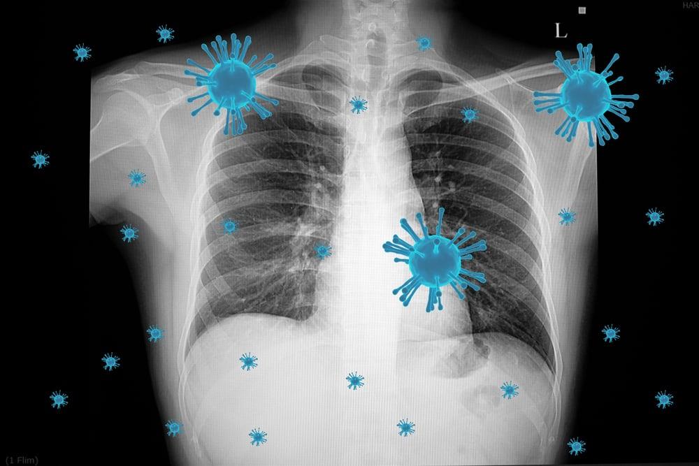 triệu chứng của viêm phổi không điển hình