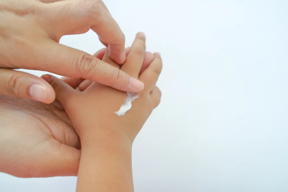 viêm da cơ địa ở trẻ