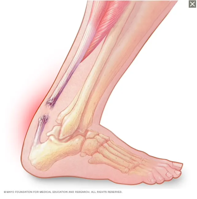 hình ảnh đứt gân gót chân