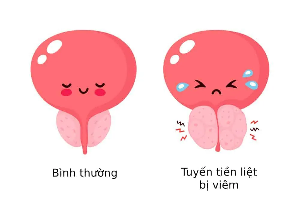 bệnh viêm tuyến tiền liệt