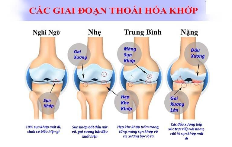 các giai đoạn thoái hóa khớp