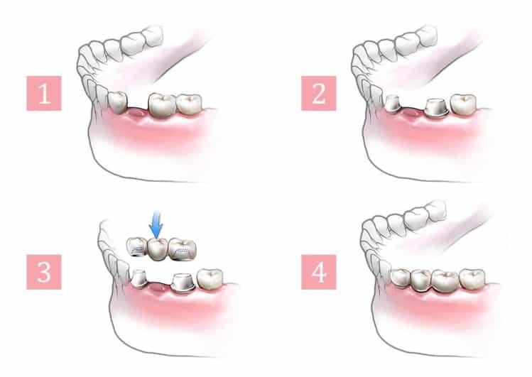 Mô phỏng kỹ thuật làm cầu răng sứ