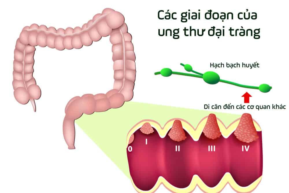 Các giai đoạn của ung thư đại tràng