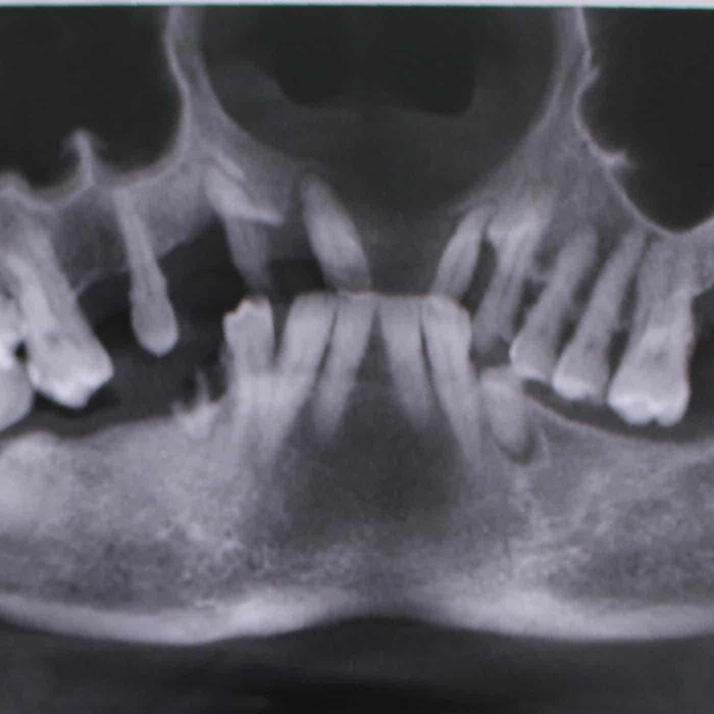 Hiện tượng xương bị mất biểu hiện trên phim CT bởi một vùng tối (gọi là thấu quang)