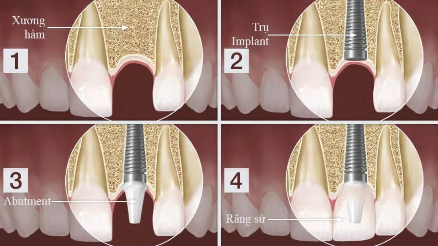 Quy trình trồng răng Implant