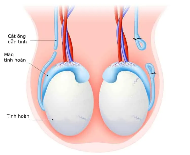 các biện pháp tránh thai: thắt ống dẫn tinh