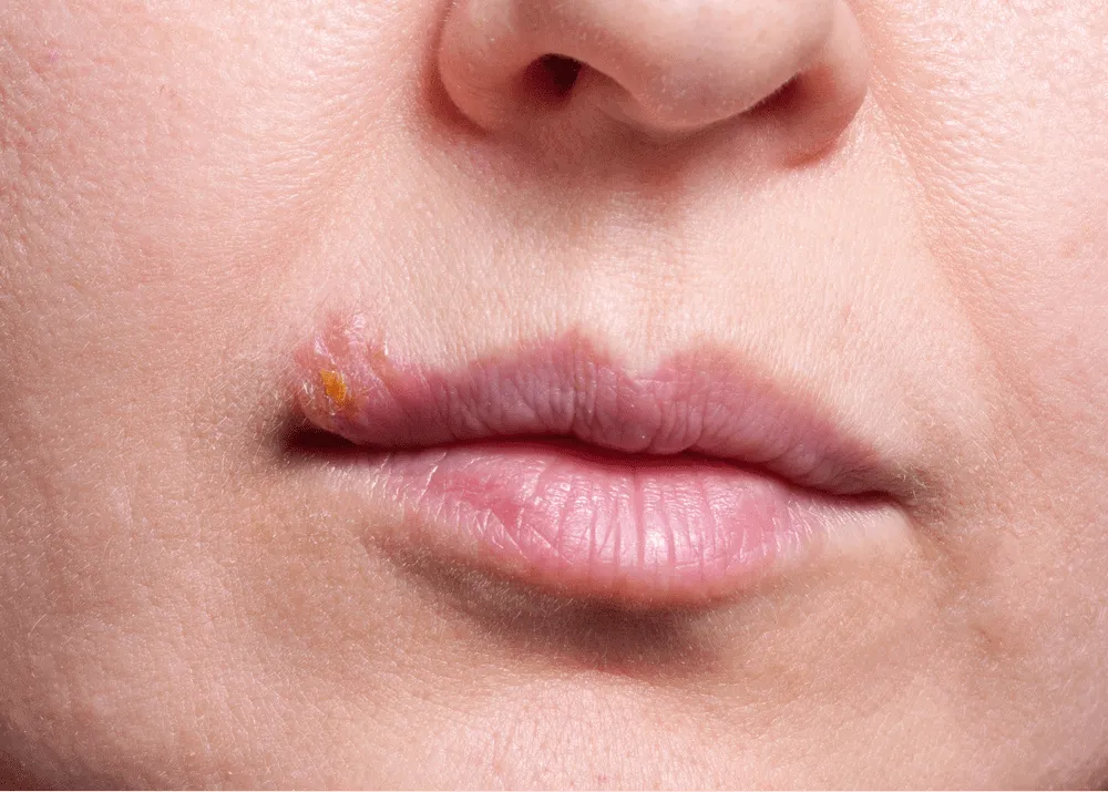 Bệnh herpes môi