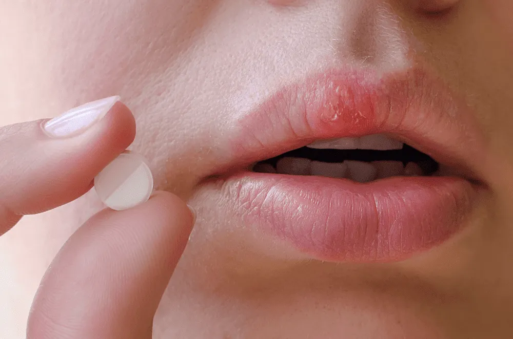 Bệnh herpes môi