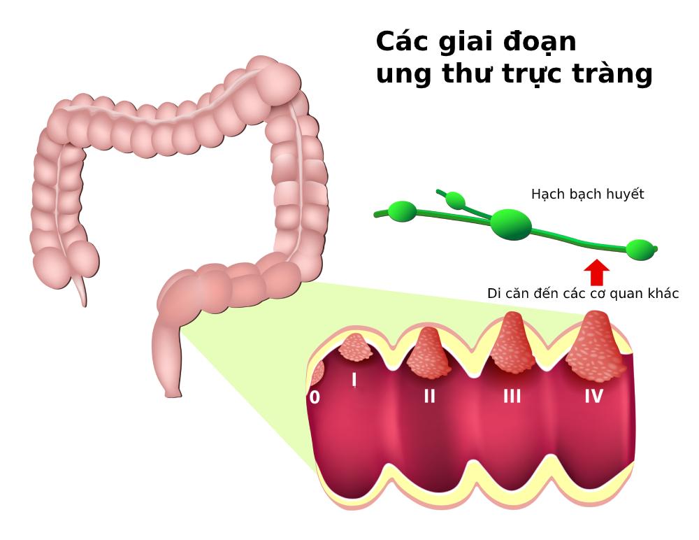 Dấu hiệu ung thư trực tràng sẽ khác nhau tùy giai đoạn bệnh