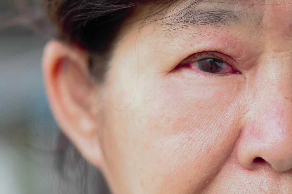 bệnh glôcôm góc đóng