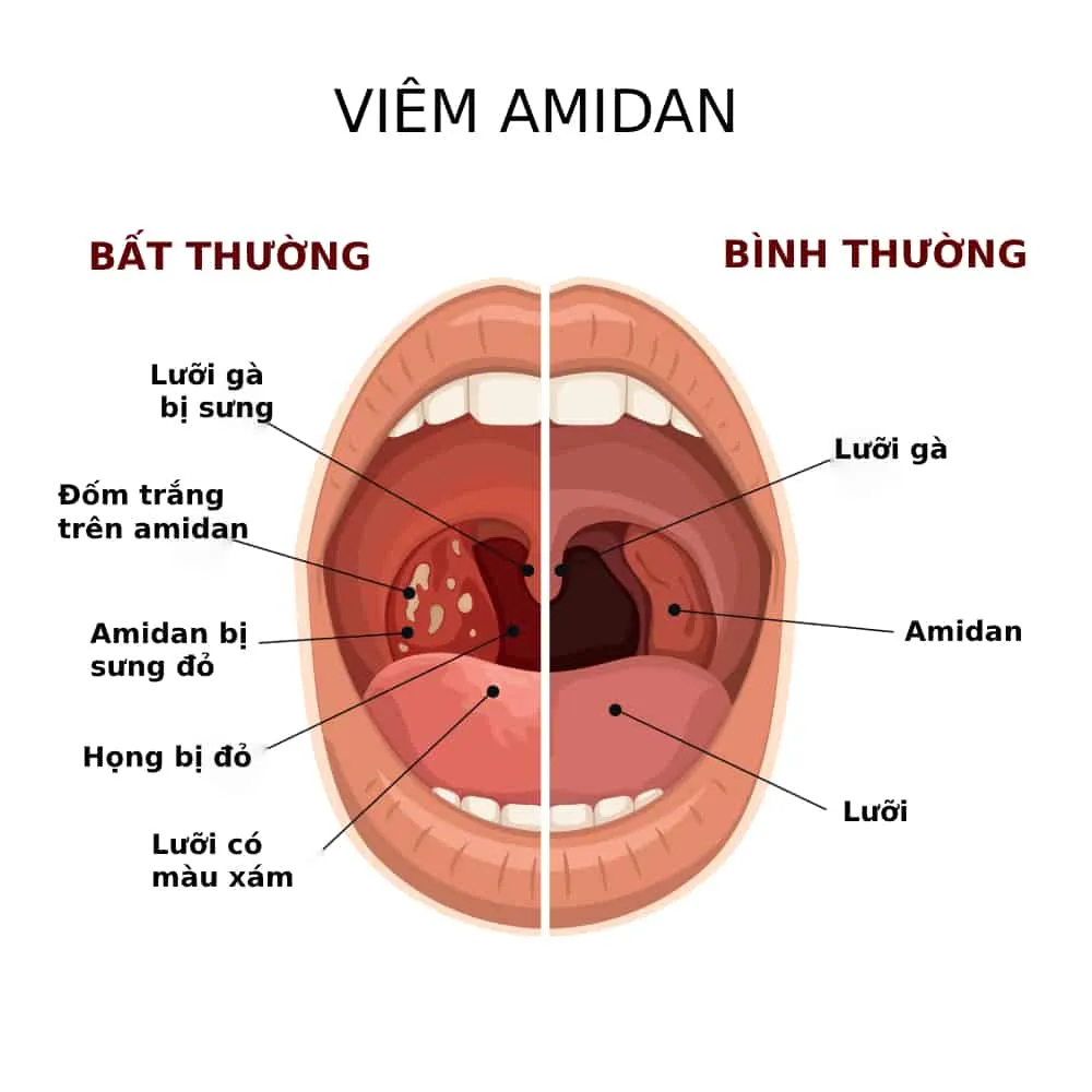triệu chứng viêm amidan hốc mủ