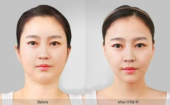 ưu điểm tiêm tan mỡ