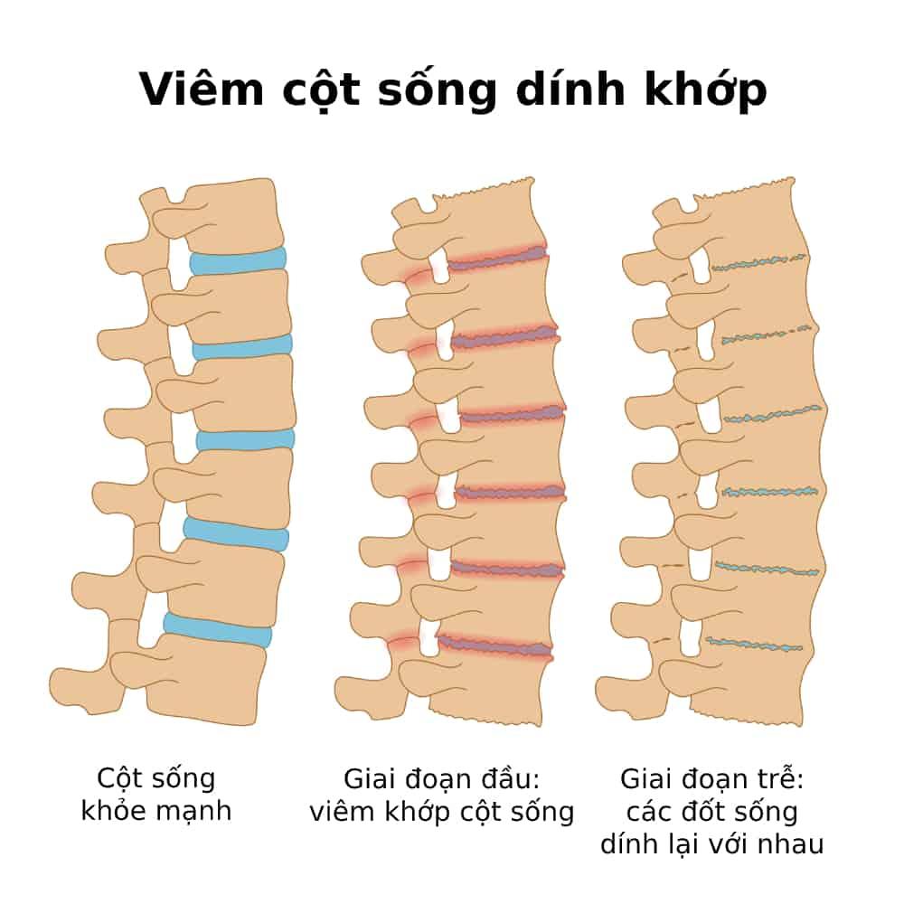 viêm cột sống dính khớp