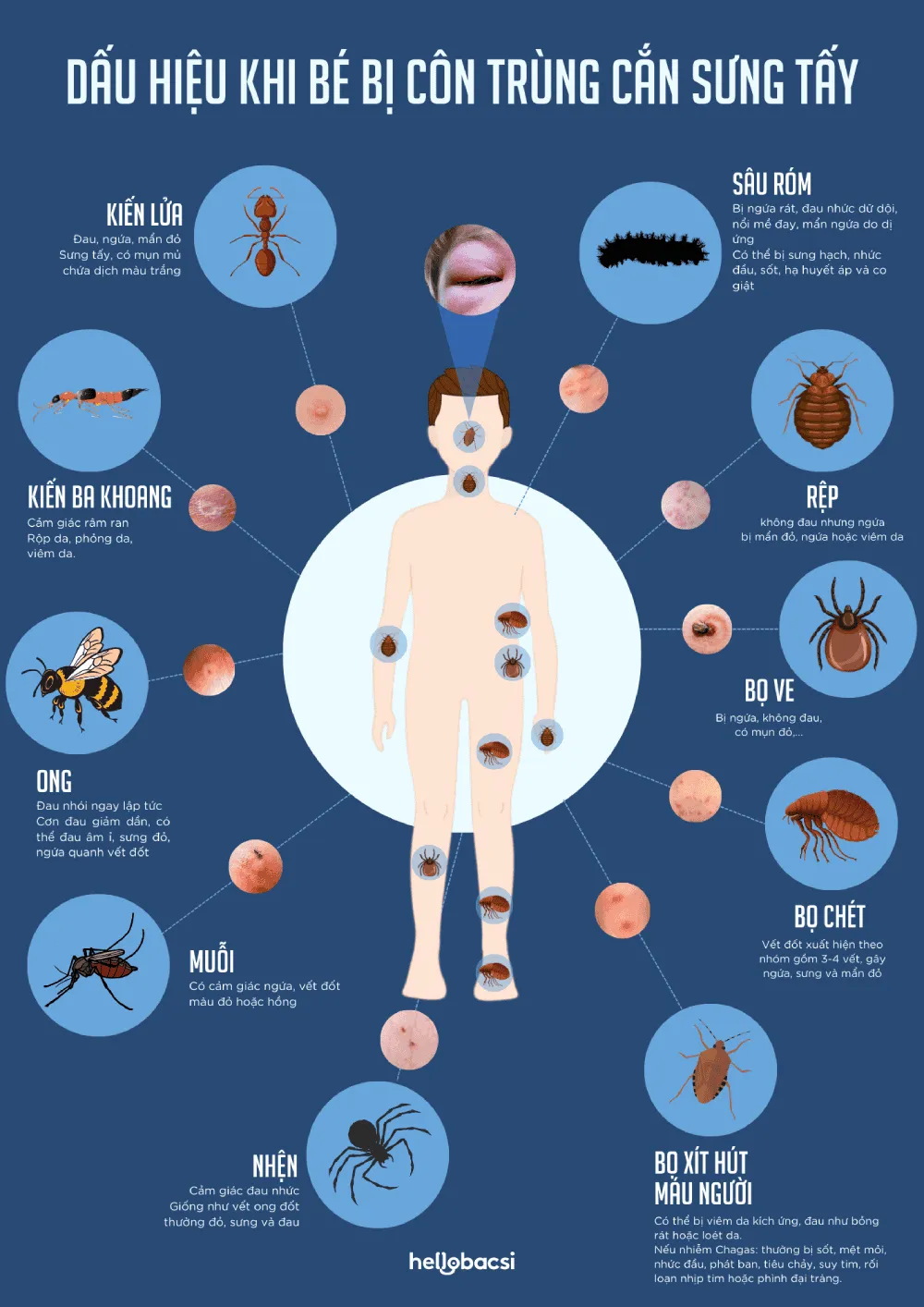 bé bị côn trùng cắn sưng tấy