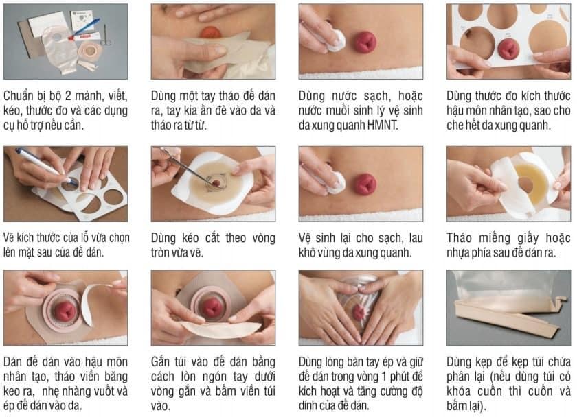 cách chăm sóc hậu môn nhân tạo