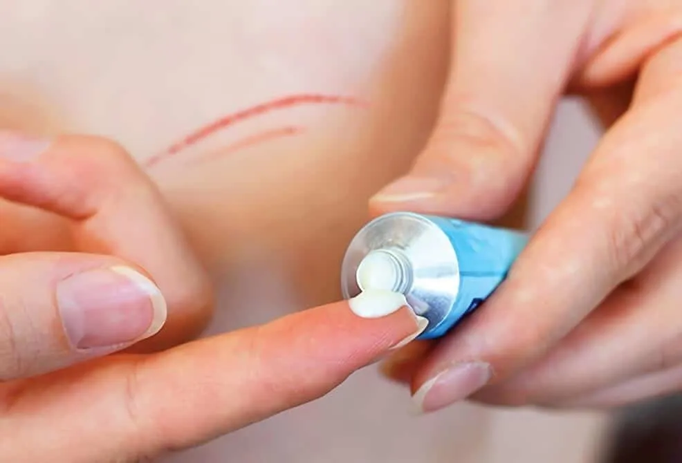 Chỉ tự tiêu trong phẫu thuật.