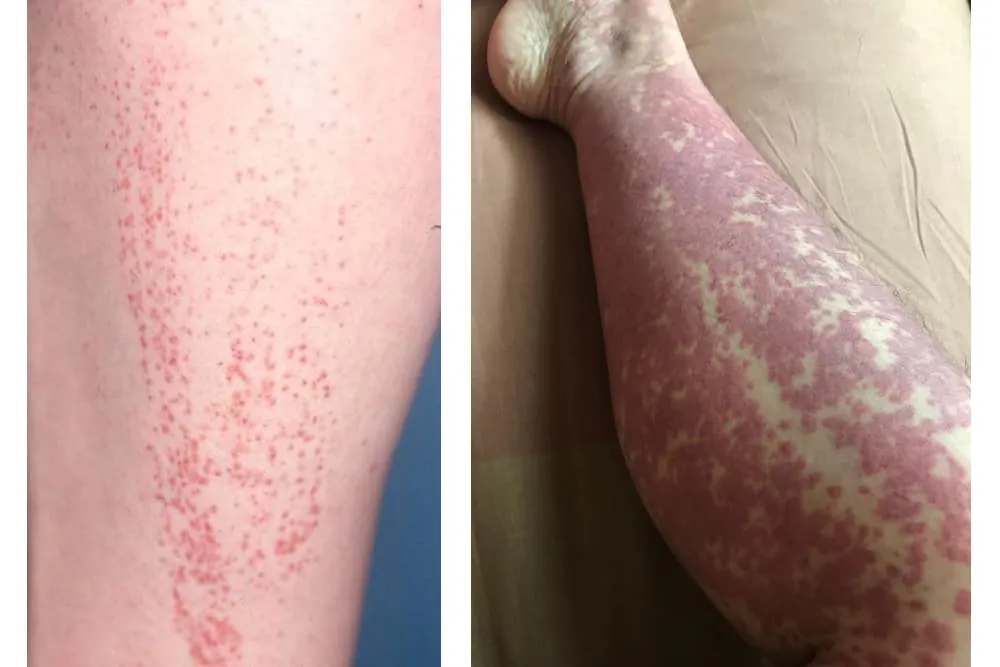 hình ảnh viêm mao mạch dị ứng