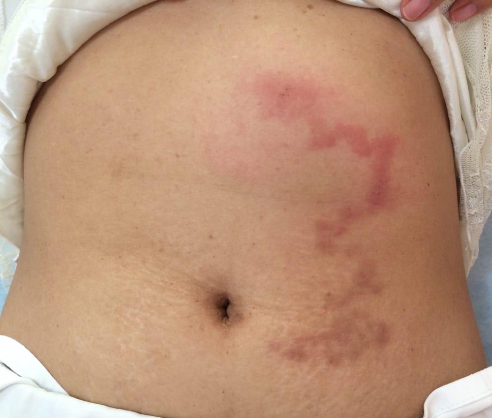 triệu chứng nhiễm giun đầu gai dưới da