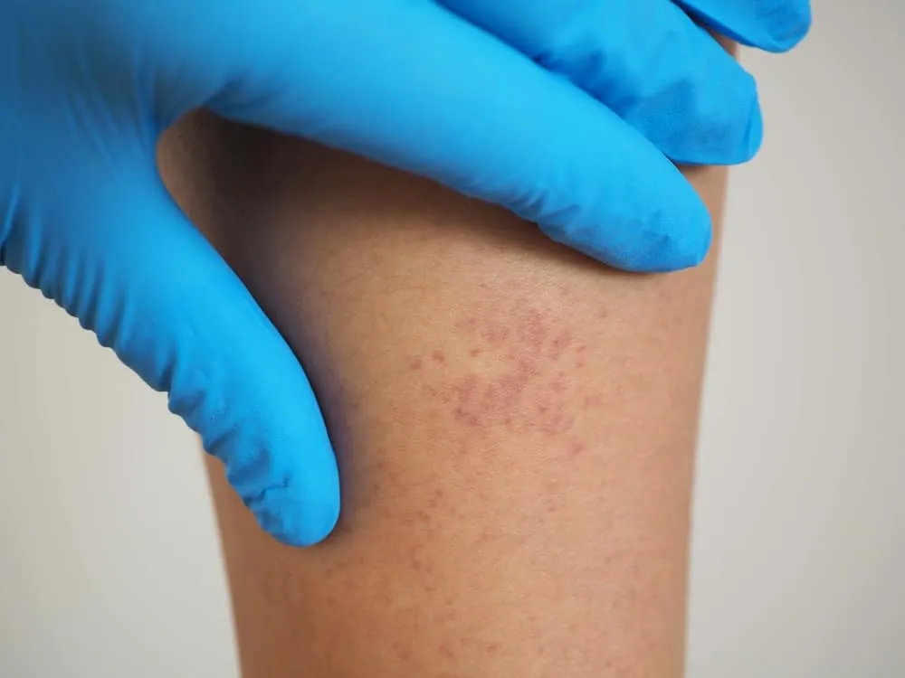 viêm mao mạch dị ứng có nguy hiểm không