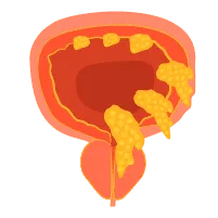 Ung thư bàng quang