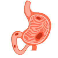 Loét dạ dày tá tràng